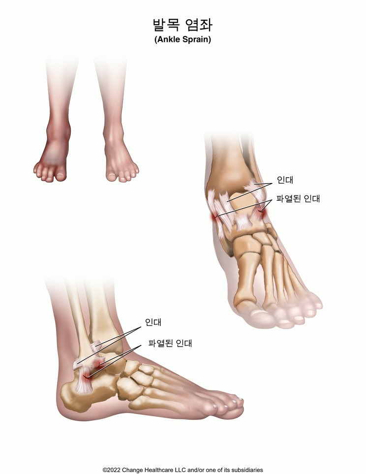 Ankle Sprain: Illustration