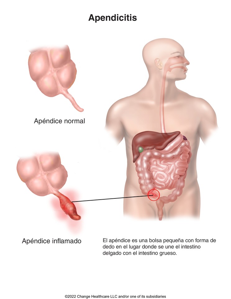 Appendicitis: Illustration
