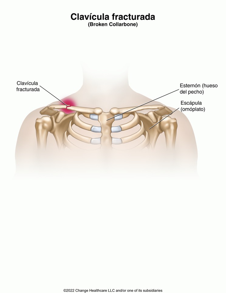 Collarbone Fracture: Illustration