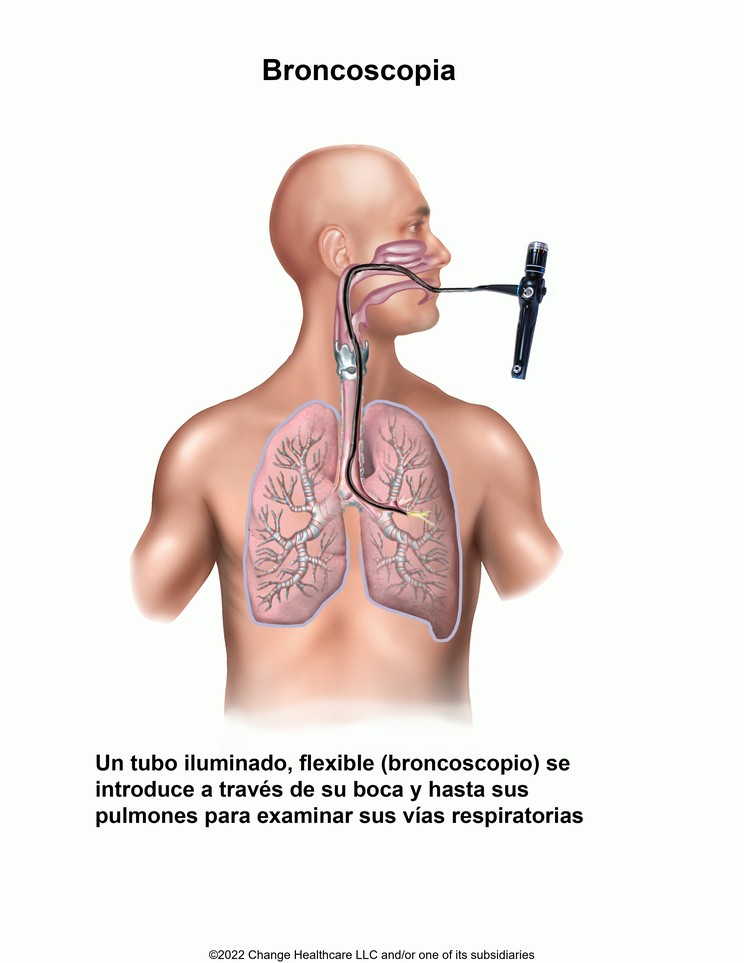 Bronchoscopy: Illustration