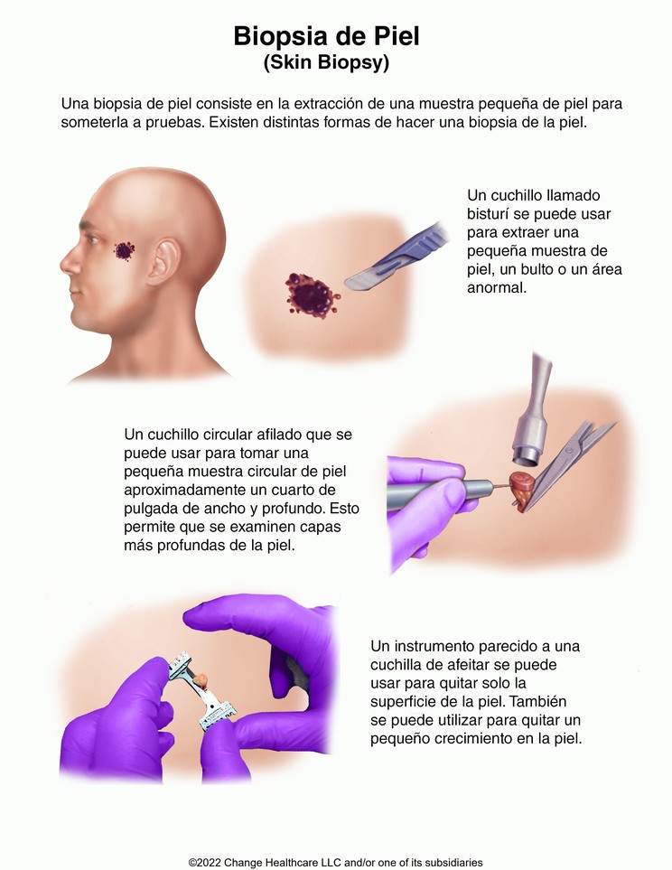 Skin Biopsy: Illustration