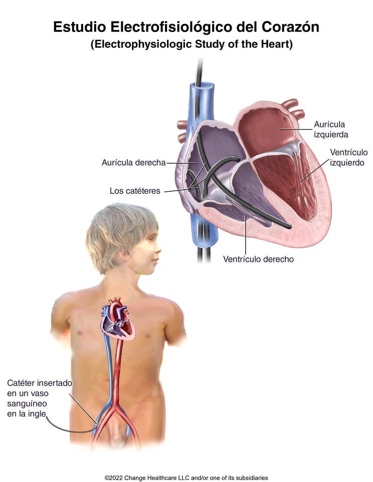 Electrophysiologic Study (EPS): Illustration