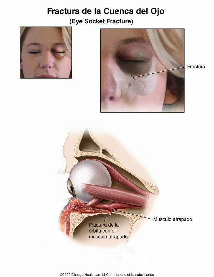 Eye Socket Fracture: Illustration