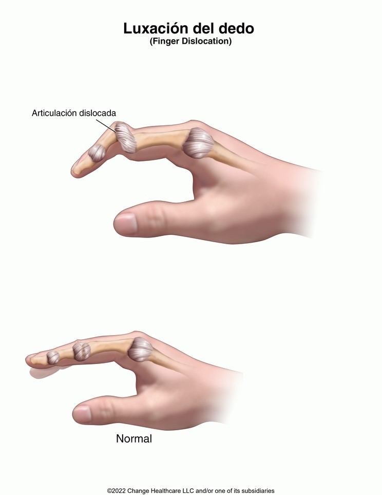 Finger Dislocation: Illustration