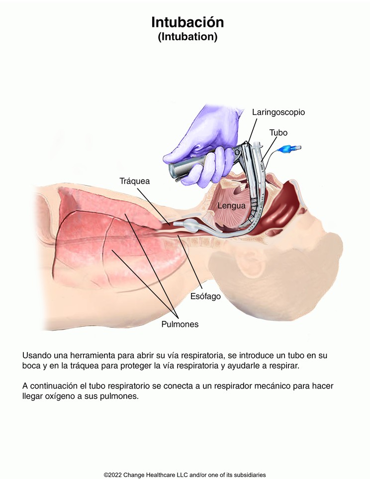 Intubation: Illustration