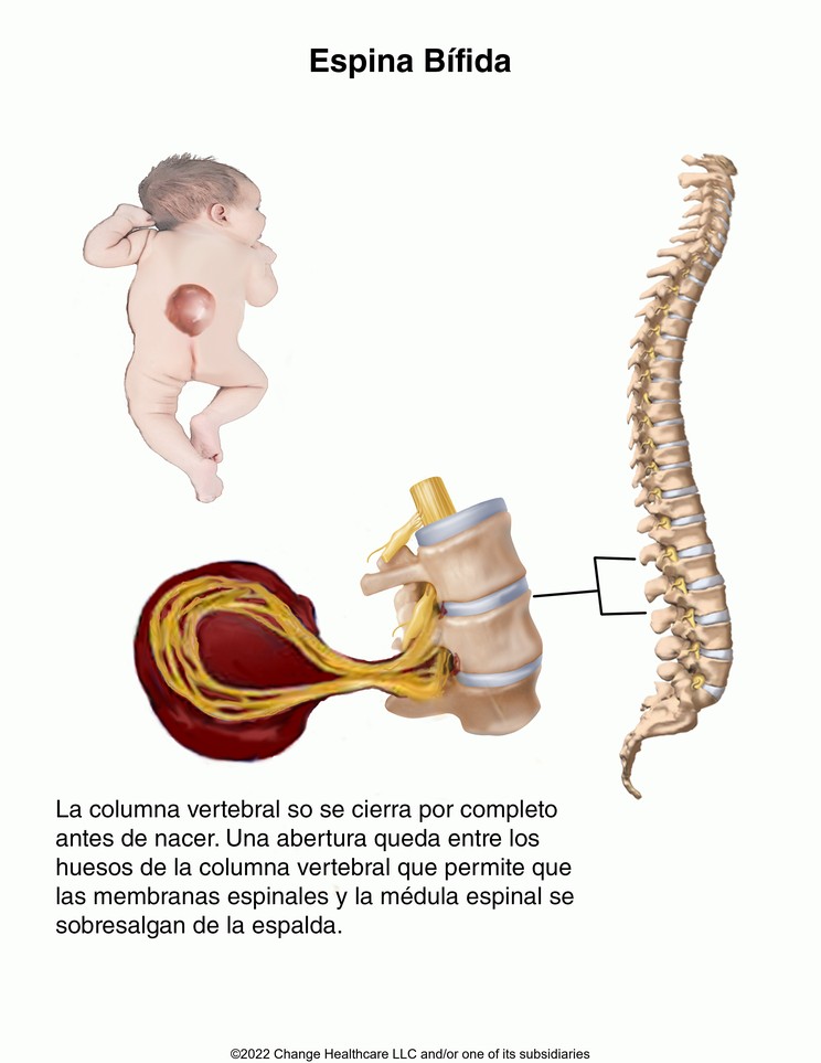 Spina Bifida: Illustration