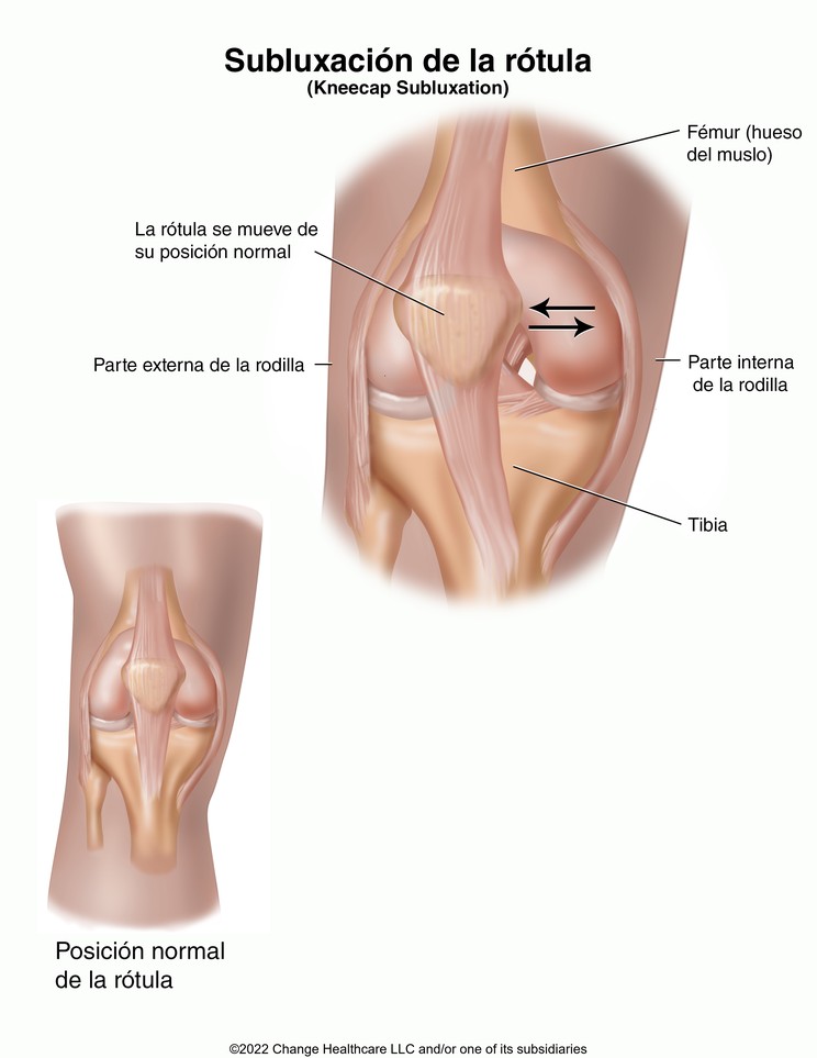 Kneecap Subluxation: Illustration