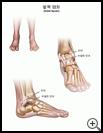 Thumbnail image of: Ankle Sprain: Illustration
