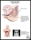 Thumbnail image of: Barium Enema: Illustration