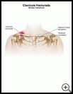 Thumbnail image of: Collarbone Fracture: Illustration