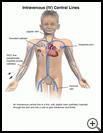 Thumbnail image of: Intravenous (IV) Central Lines: Illustration