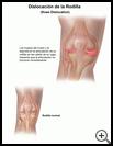 Thumbnail image of: Knee Dislocation: Illustration