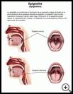 Thumbnail image of: Epiglottitis: Illustration