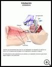 Thumbnail image of: Intubation: Illustration