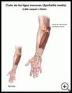 Thumbnail image of: Little Leaguer's Elbow (Medial Apophysitis): Illustration