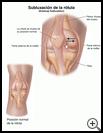 Thumbnail image of: Kneecap Subluxation: Illustration