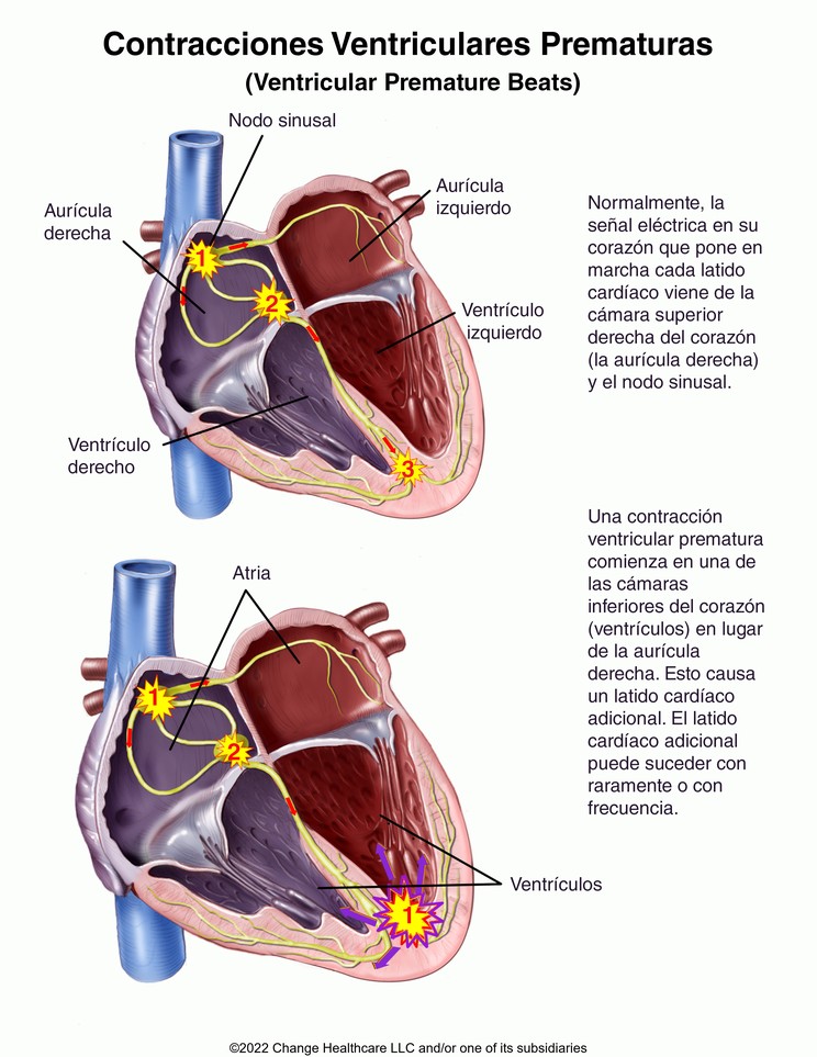 Ventricular Premature Beats: Illustration