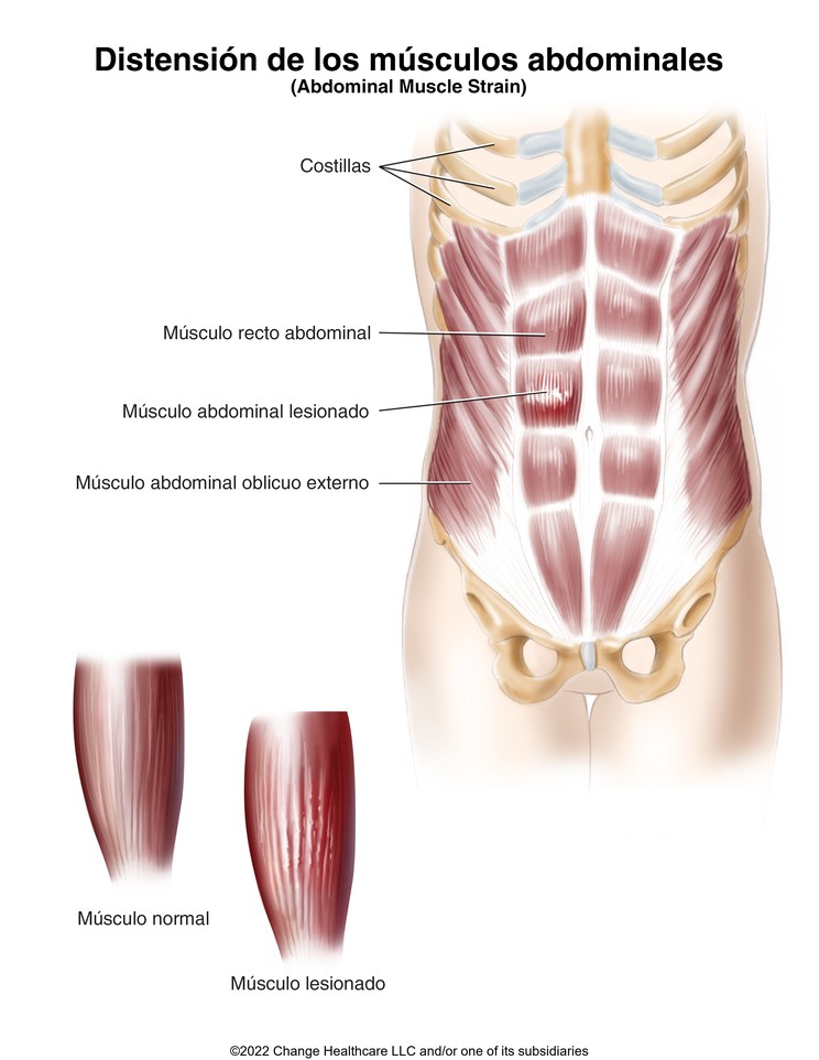 Abdominal Muscle Strain: Illustration