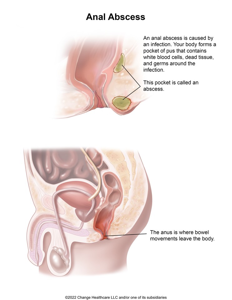 Anal Abscess: Illustration