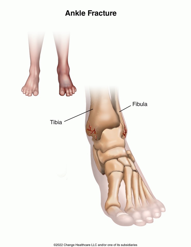Ankle Fracture: Illustration