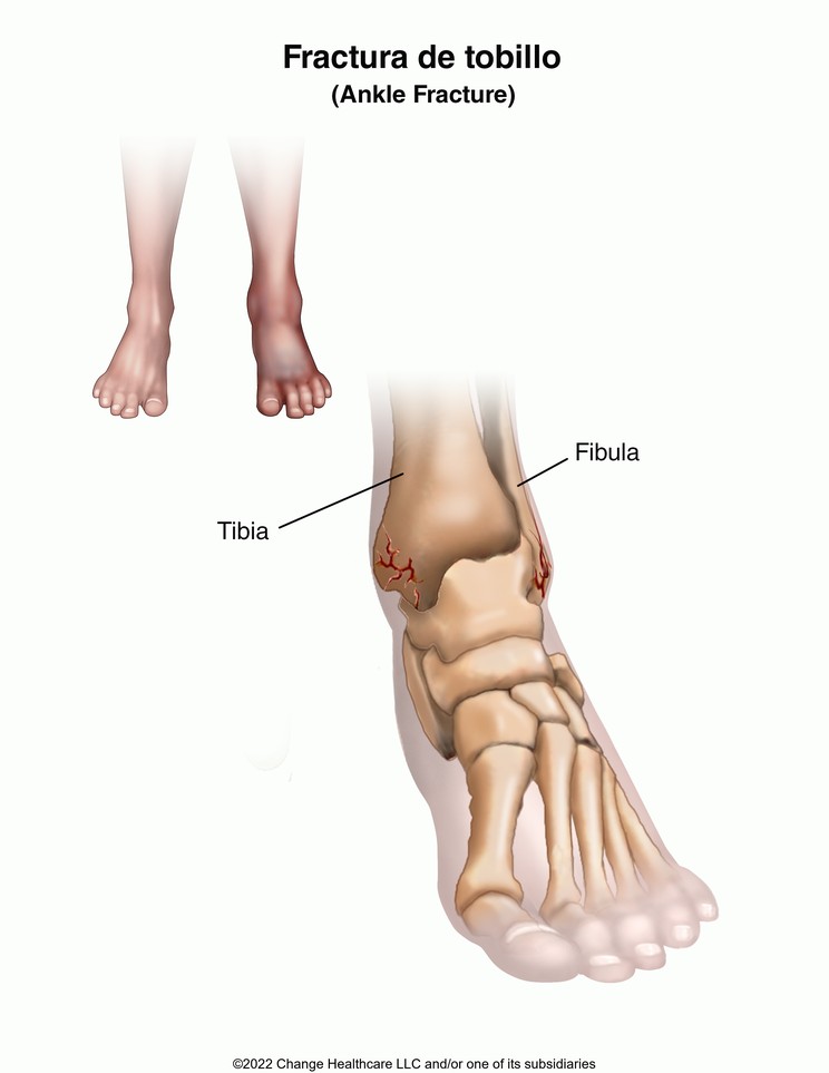 Ankle Fracture: Illustration