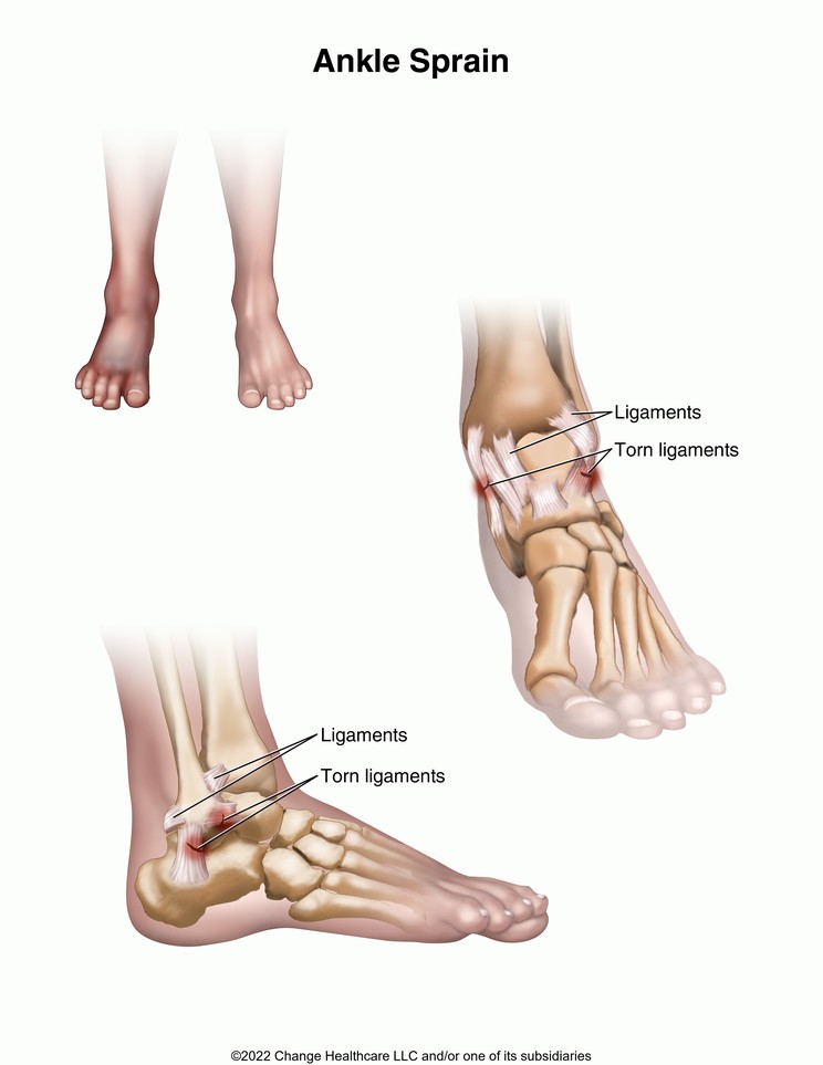 Ankle Sprain: Illustration