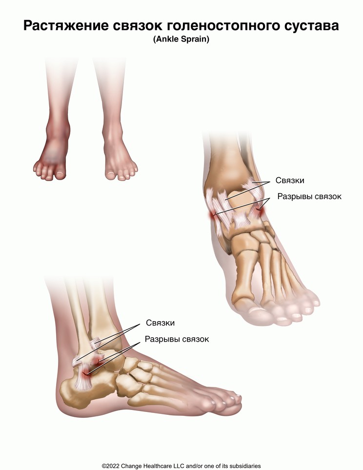 Ankle Sprain: Illustration