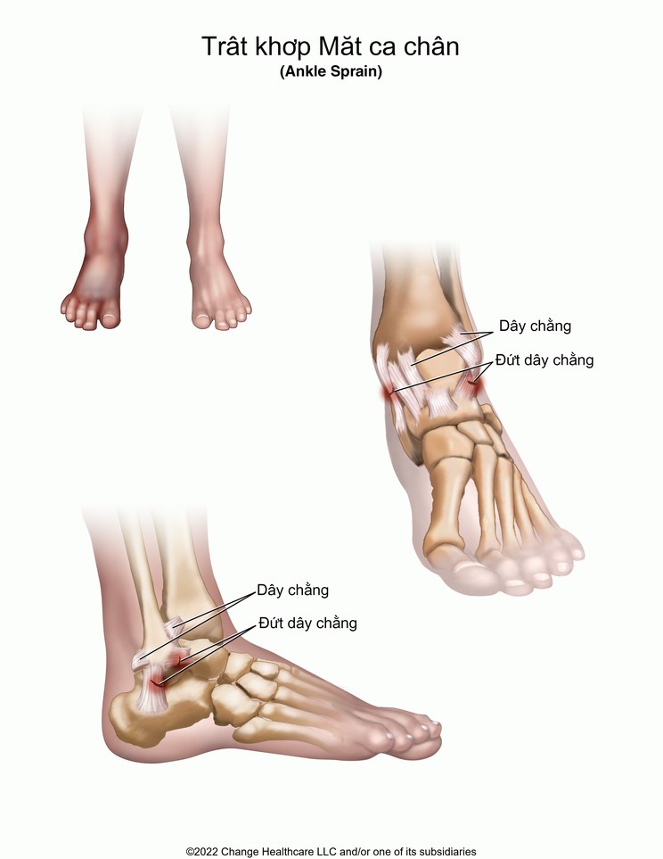 Ankle Sprain: Illustration