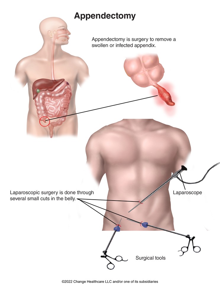 Appendectomy: Illustration