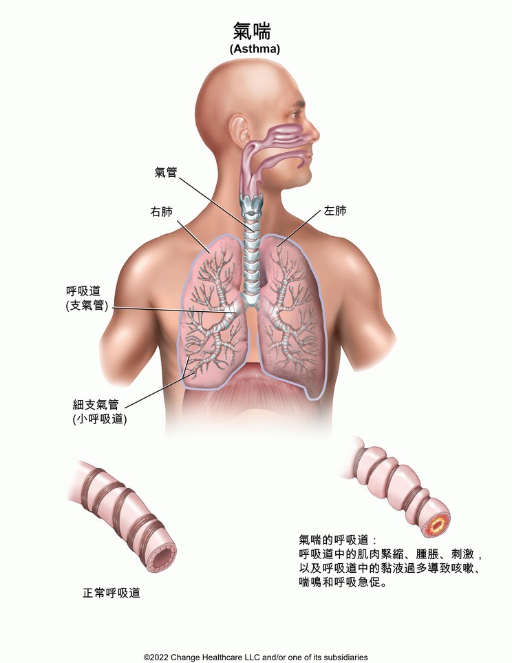 Asthma: Illustration