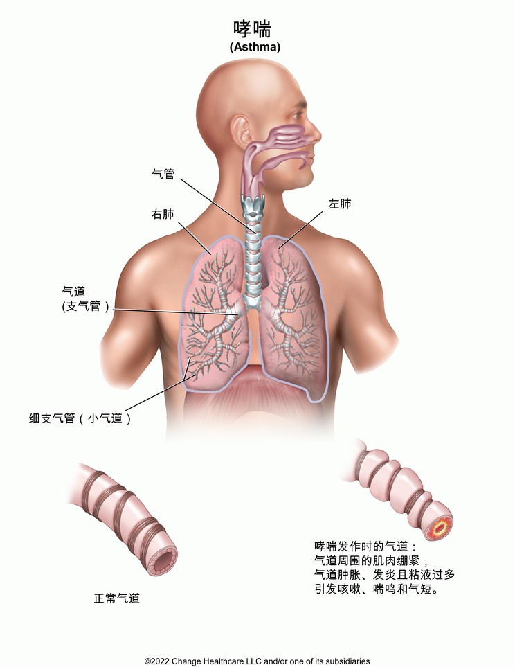 Asthma: Illustration