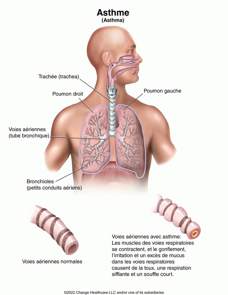 Asthma: Illustration