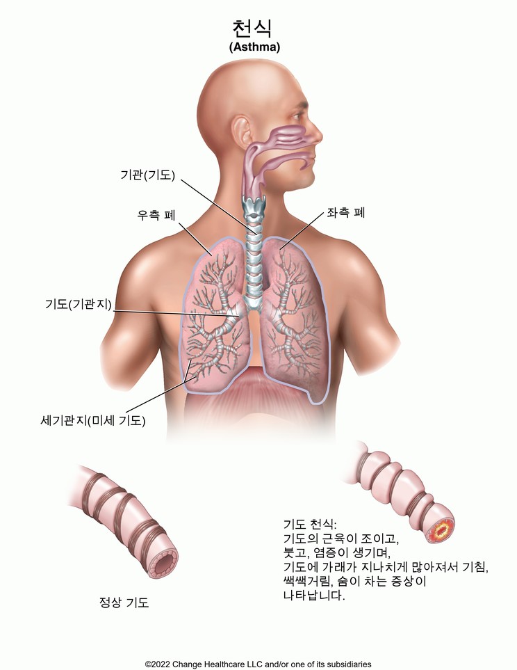 Asthma: Illustration