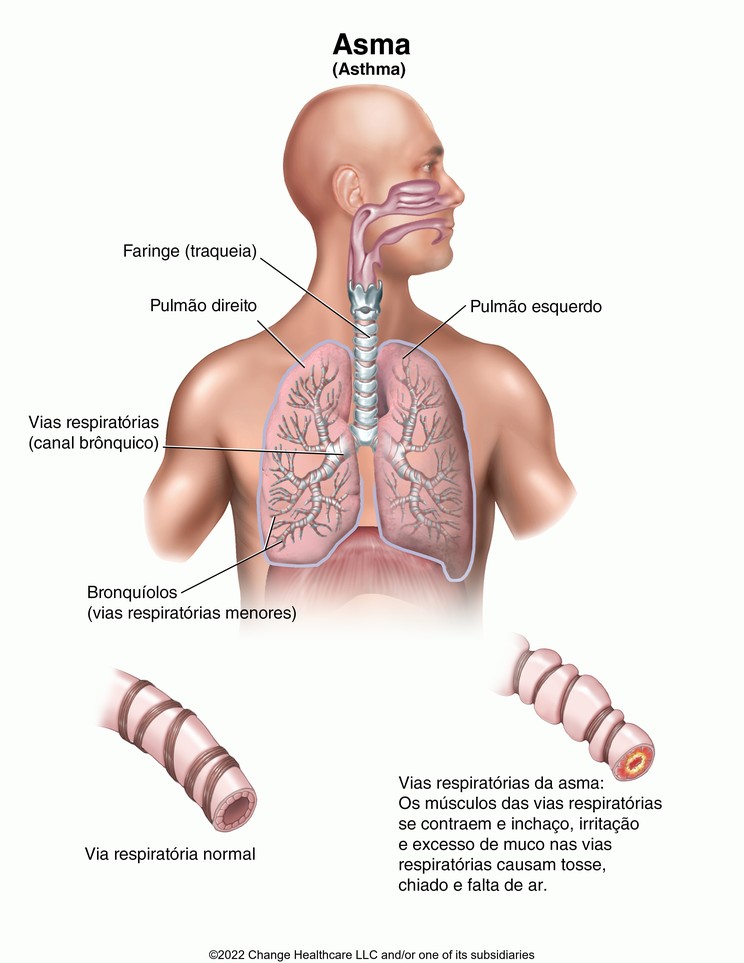 Asthma: Illustration