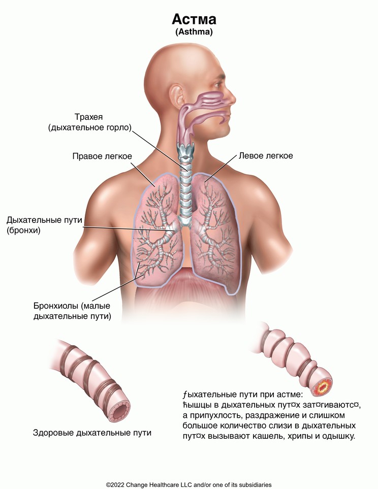 Asthma: Illustration