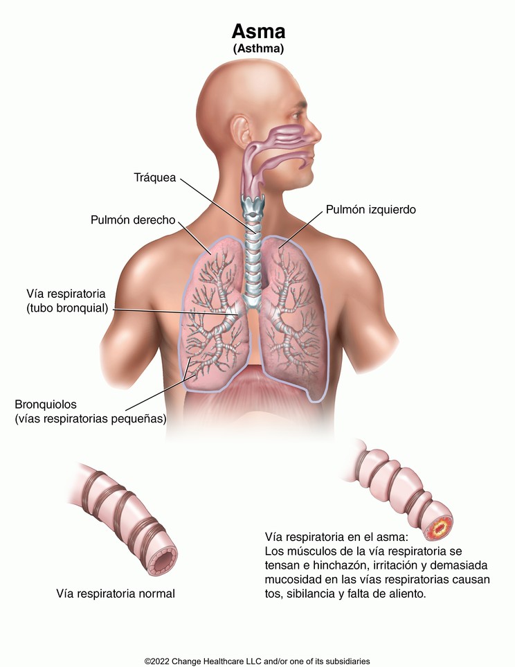 Asthma: Illustration