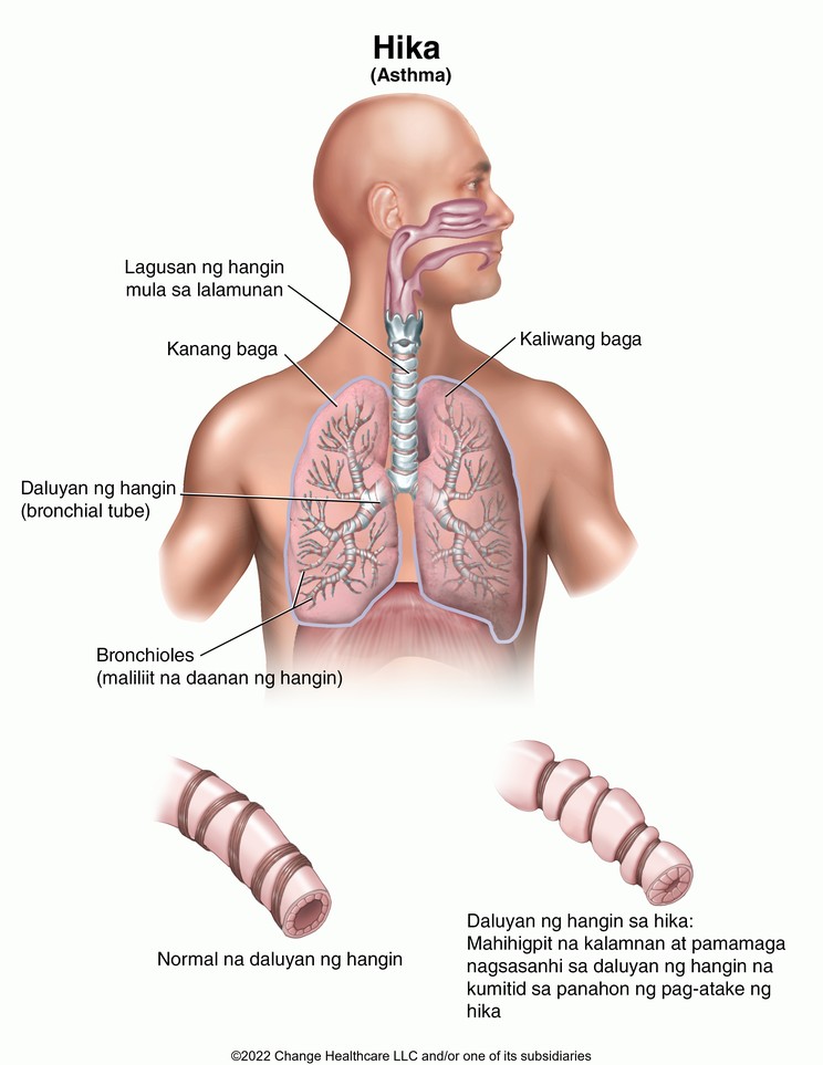 Asthma: Illustration