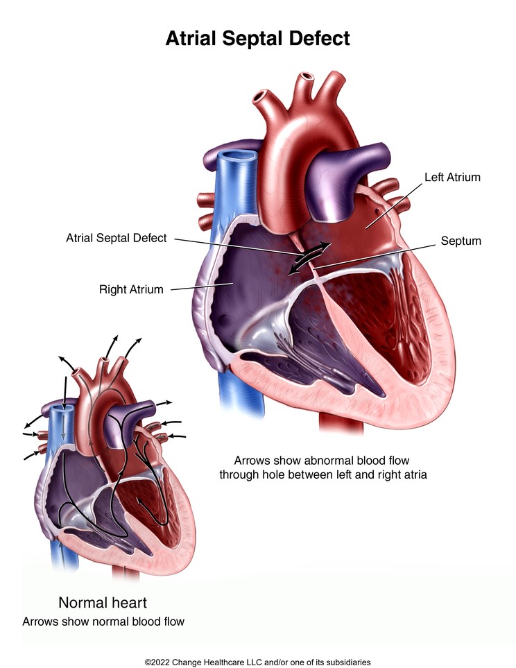 Atrial Septal Defect: Illustration