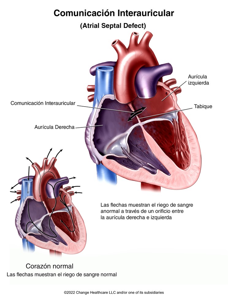 Atrial Septal Defect: Illustration