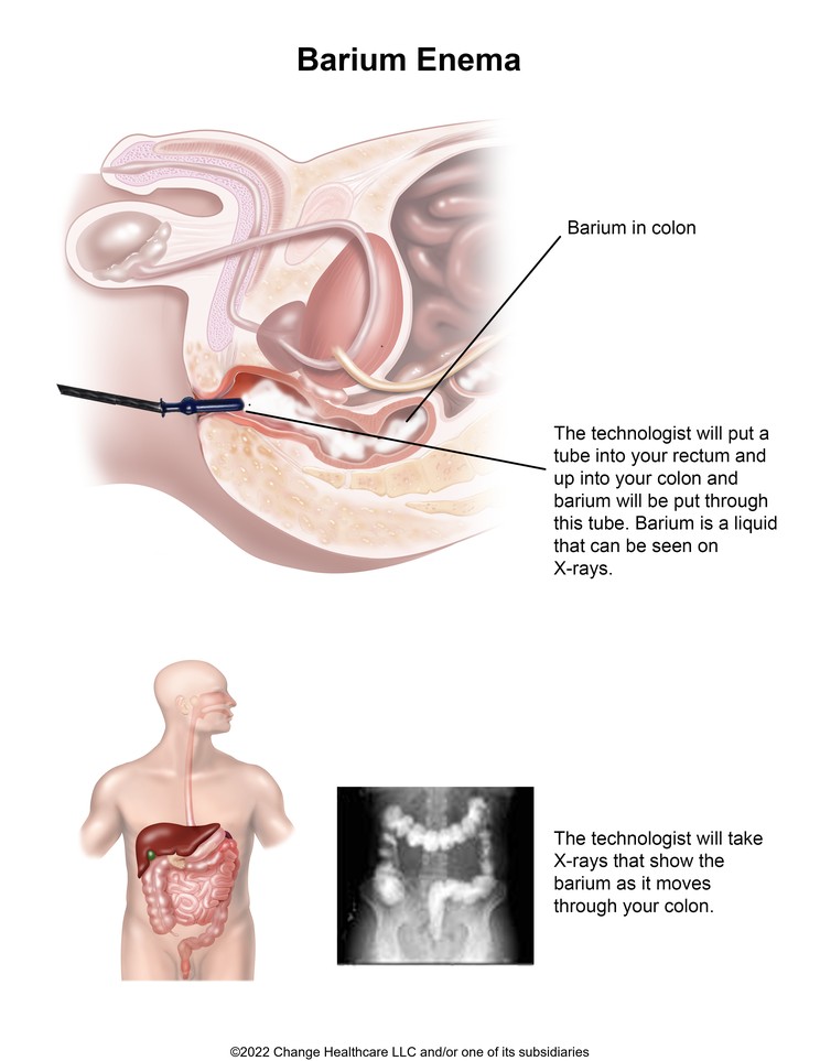 Barium Enema: Illustration