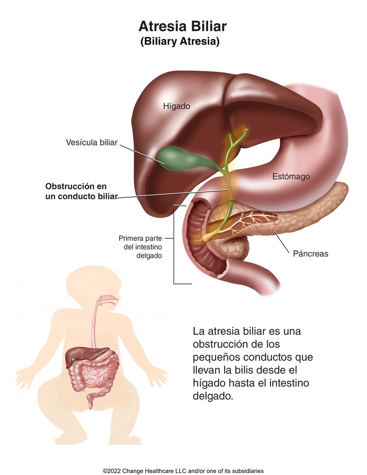 Biliary Atresia: Illustration