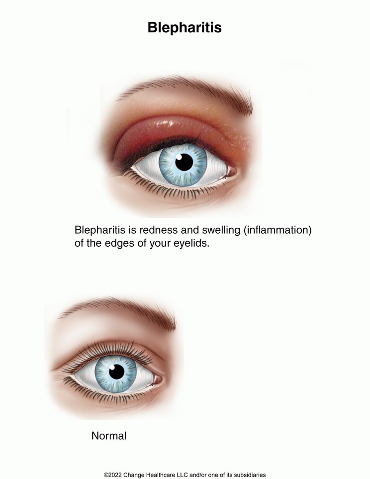 Inflamed Eyelid (Blepharitis): Illustration