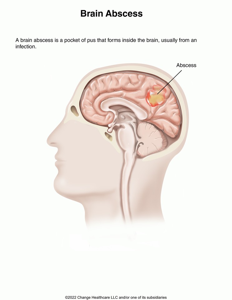 Brain Abscess: Illustration