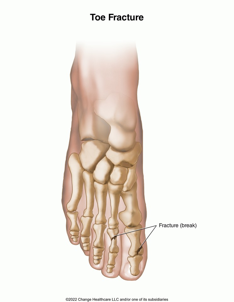 Toe Fracture: Illustration