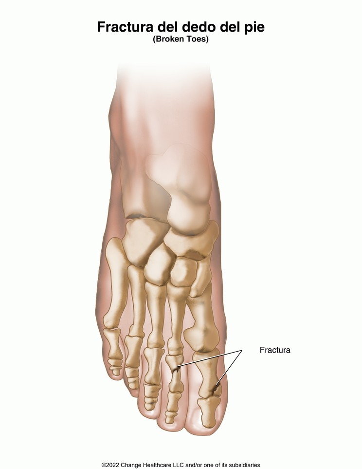 Toe Fracture: Illustration