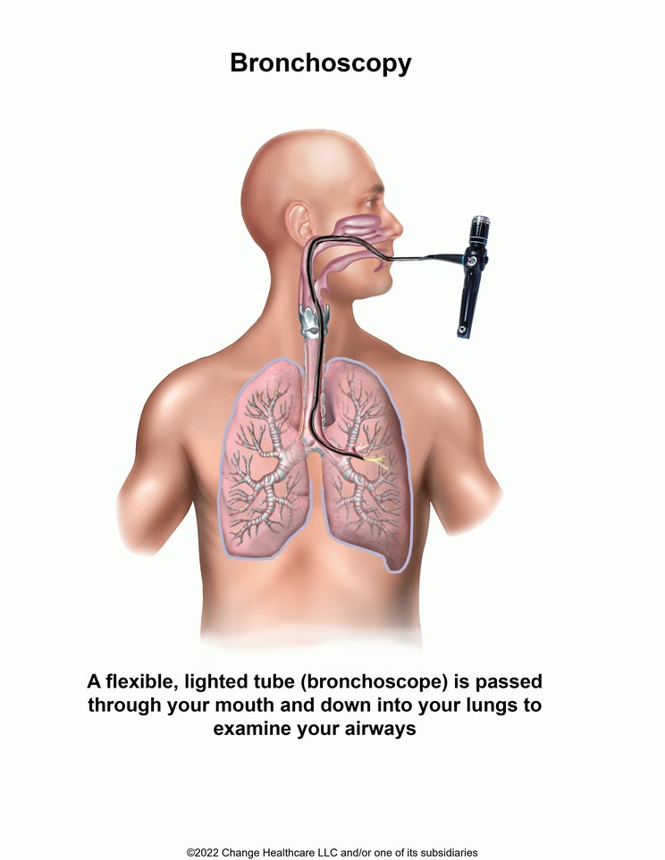 Bronchoscopy: Illustration