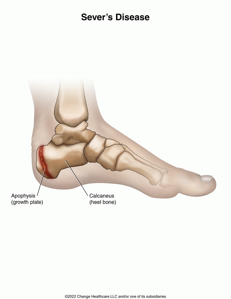 Sever's Disease: Illustration