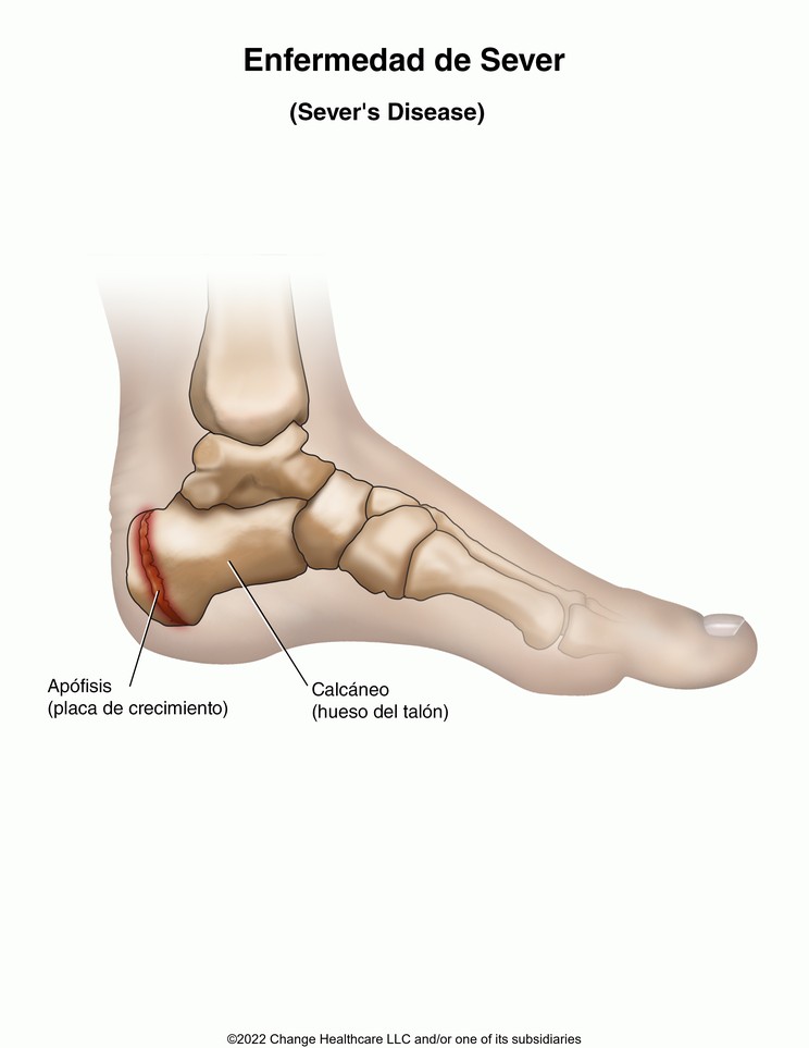 Sever's Disease: Illustration