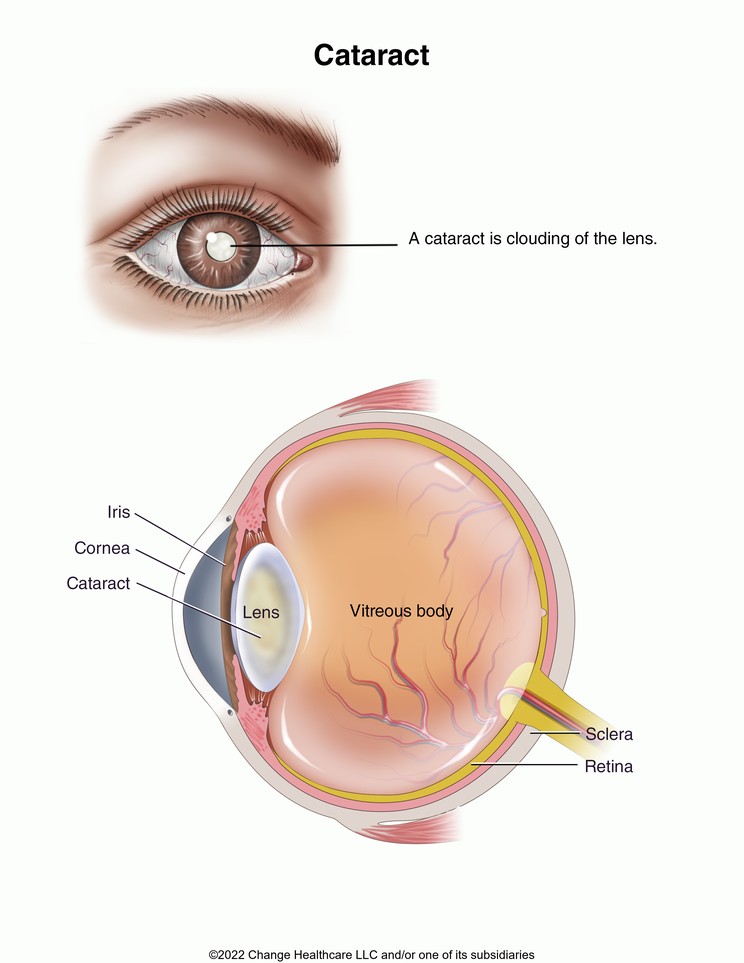 Cataract: Illustration