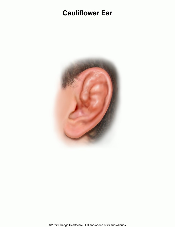 Cauliflower Ear: Illustration